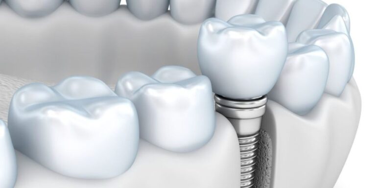 How Tooth Replacement Options Preserve Jawbone Structure