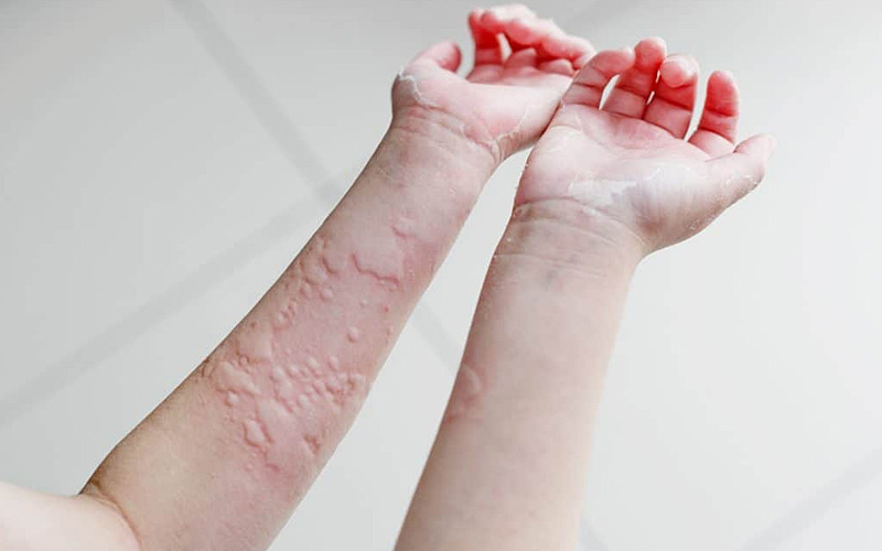 Why Allergies Worsen in Spring and How to Manage Them