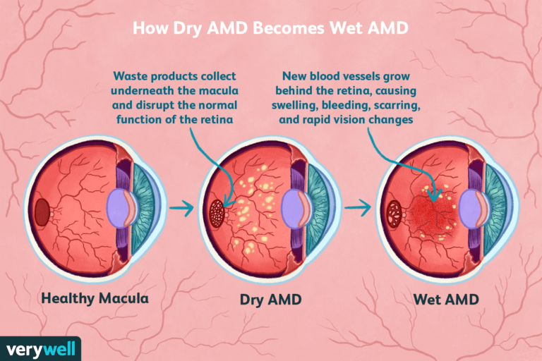 Exploring the Types and Stages of Macular Degeneration